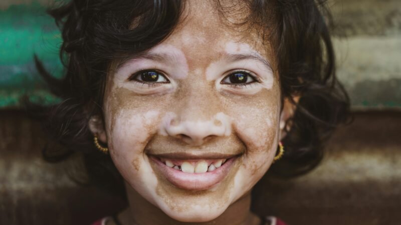 O que é o Vitiligo: Causas, diagnóstico e tratamento